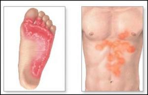 Micosis